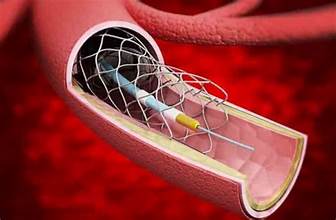Embolic Protection Device Market Size And Report Forecast 2024-2032 1 Embolic Protection Device Market Size And Report Forecast 2024-2032