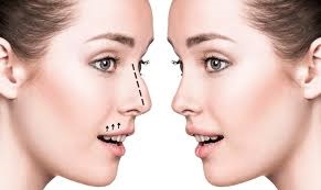 احصل على شكل أنف أكثر دقة مع عملية تجميل الأنف في دبي 1 احصل على شكل أنف أكثر دقة مع عملية تجميل الأنف في دبي