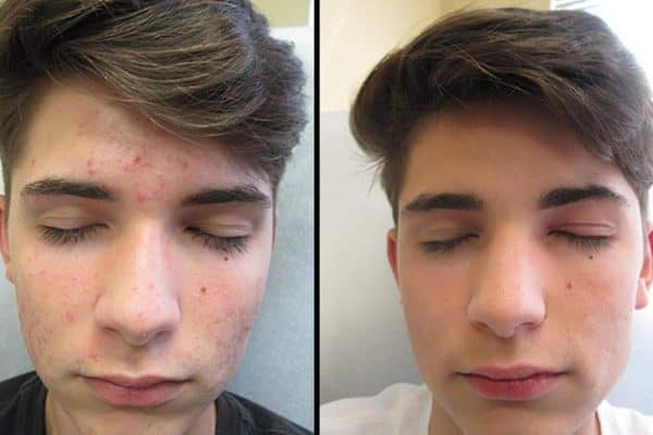 Laser Scar Removal : Top Treatments in London 1 Laser Scar Removal : Top Treatments in London