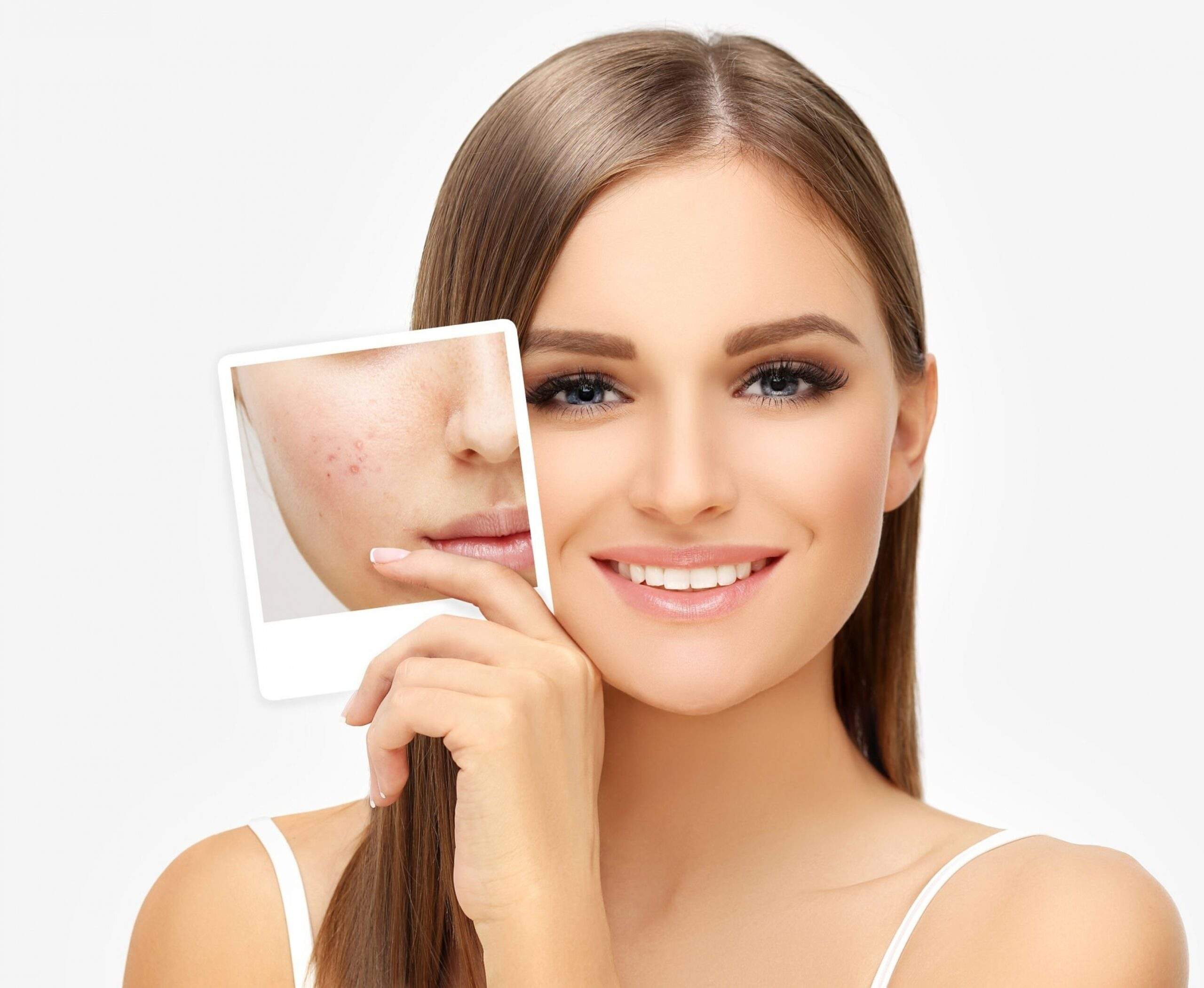 The Ultimate Guide to Acne Treatment in Bangalore: What You Need to Know