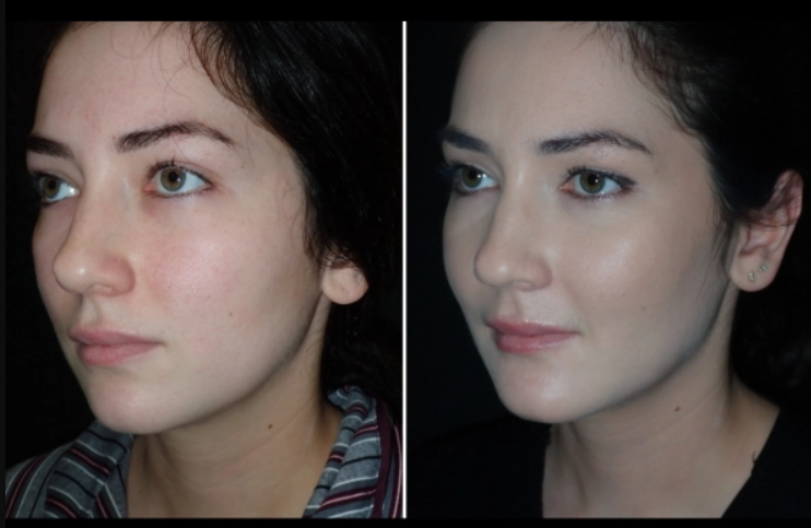 How to Stay Hydrated After Facial Fat Transfer Surgery 1 How to Stay Hydrated After Facial Fat Transfer Surgery