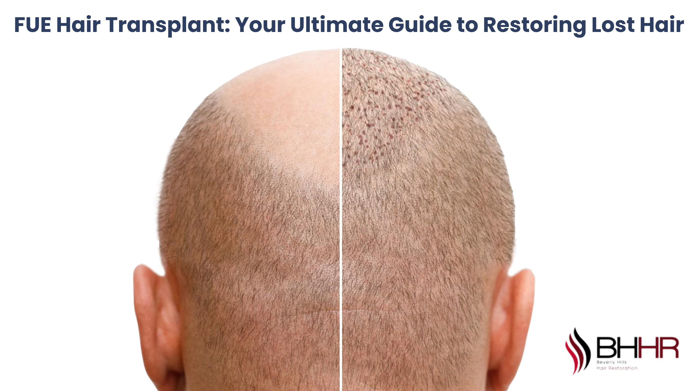 FUE Hair Transplant: Your Ultimate Guide to Restoring Lost Hair 1 FUE Hair Transplant: Your Ultimate Guide to Restoring Lost Hair