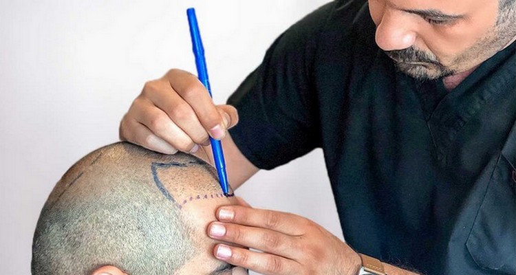 Finding the Best Hair Transplant Solutions in Lahore - A Comprehensive Guide 1 Finding the Best Hair Transplant Solutions in Lahore – A Comprehensive Guide