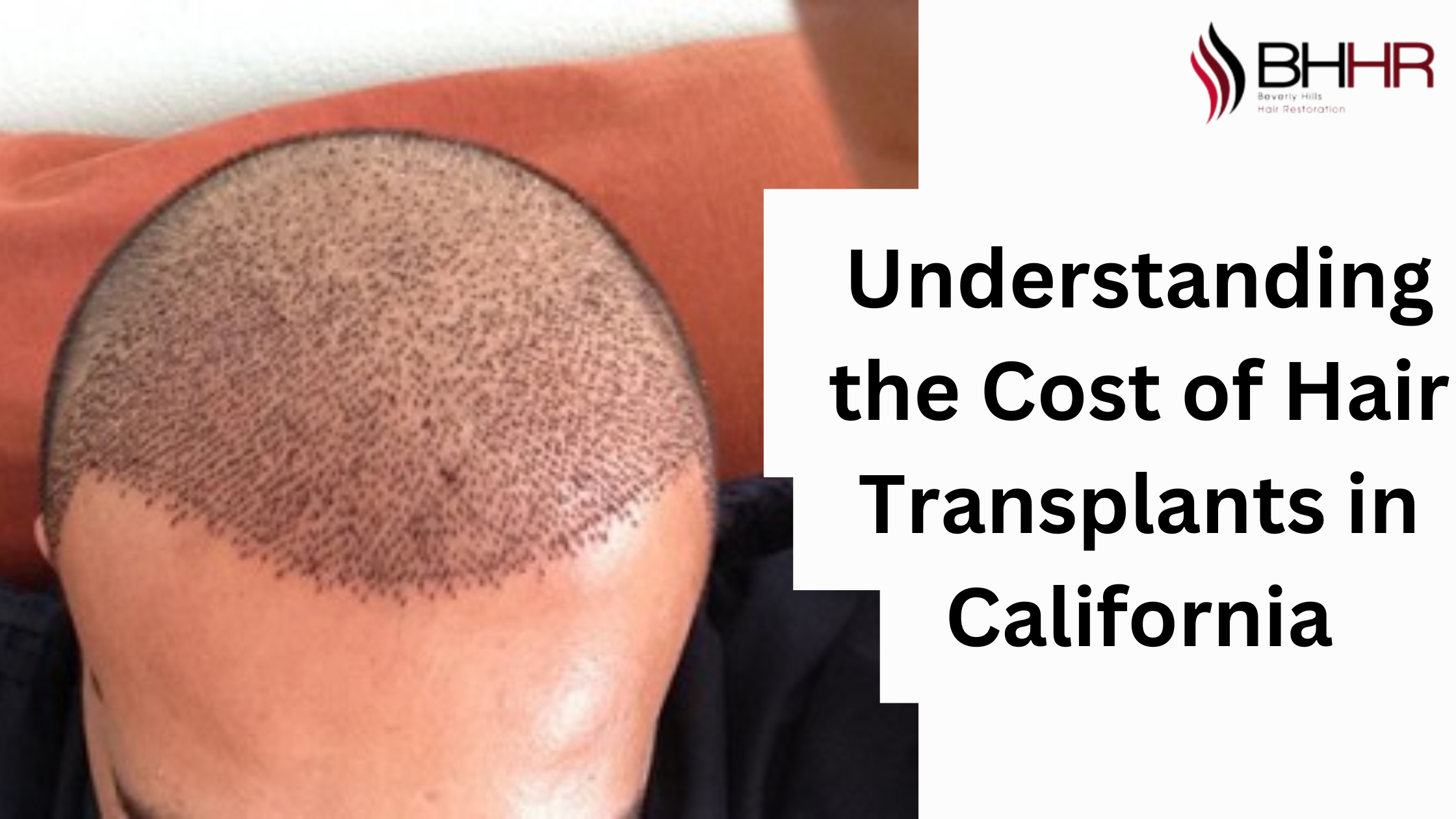 Understanding the Cost of Hair Transplants in California