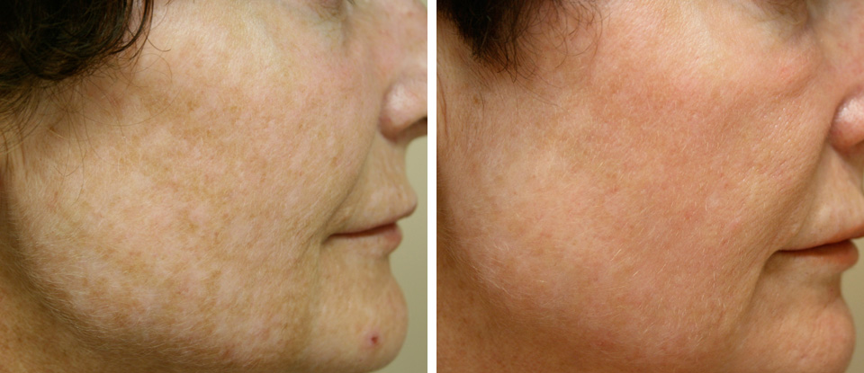 Fractional Laser Queen Street East Toronto 1 Fractional Laser Queen Street East Toronto