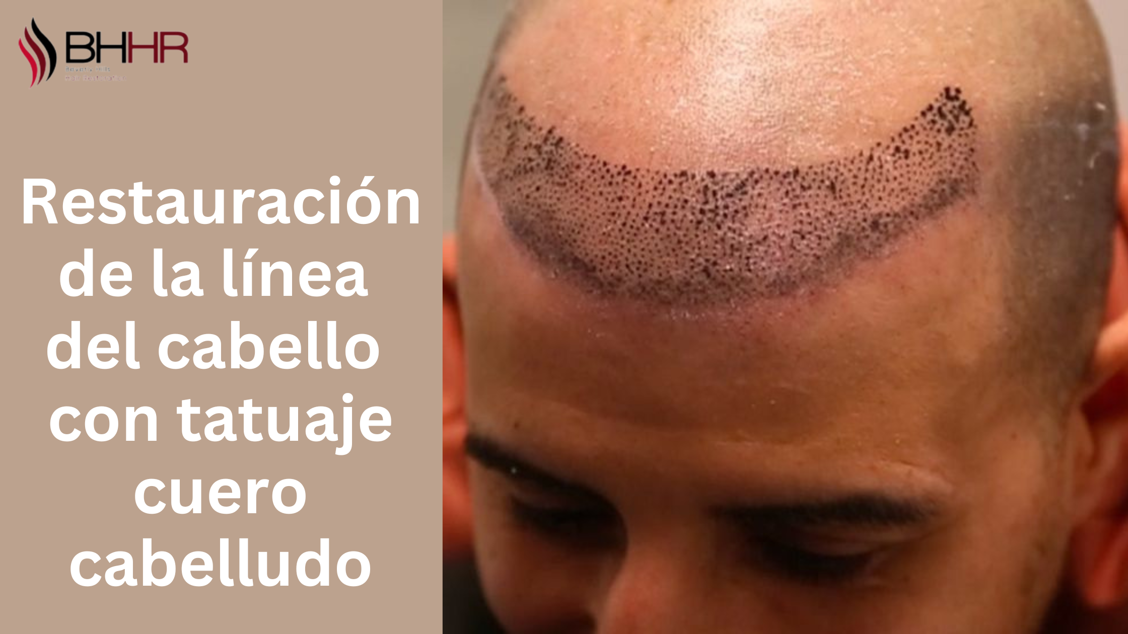 Restauración de la línea del cabello con tatuaje cuero cabelludo