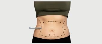 Navigating Social Situations After Full Body Liposuction Surgery in Dubai