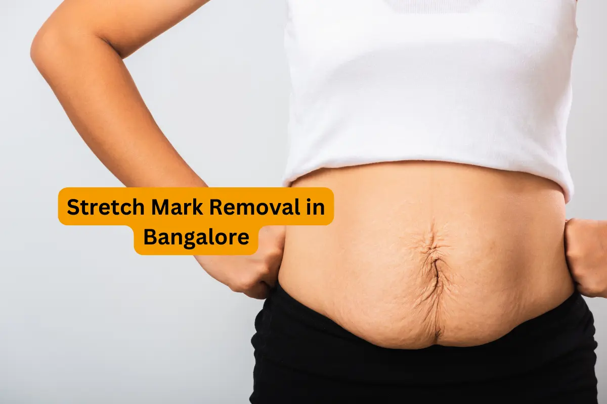 Transform Your Skin: Effective Methods for Permanent Stretch Mark Removal in Bangalore 1 Transform Your Skin: Effective Methods for Permanent Stretch Mark Removal in Bangalore