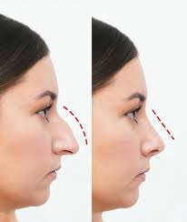 🔬 Precision & Expertise: Top Rhinoplasty in Dubai 1 🔬 Precision & Expertise: Top Rhinoplasty in Dubai