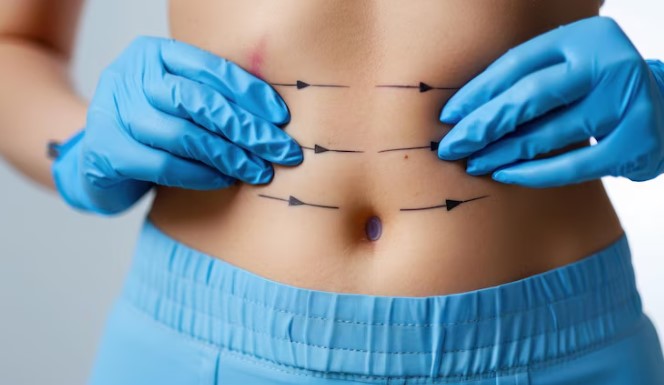 Tummy Tuck Benefits After Pregnancy and Weight Loss 1 Tummy Tuck Benefits After Pregnancy and Weight Loss