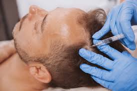 PRP Hair Treatment: How It Can Help with Genetic Hair Loss