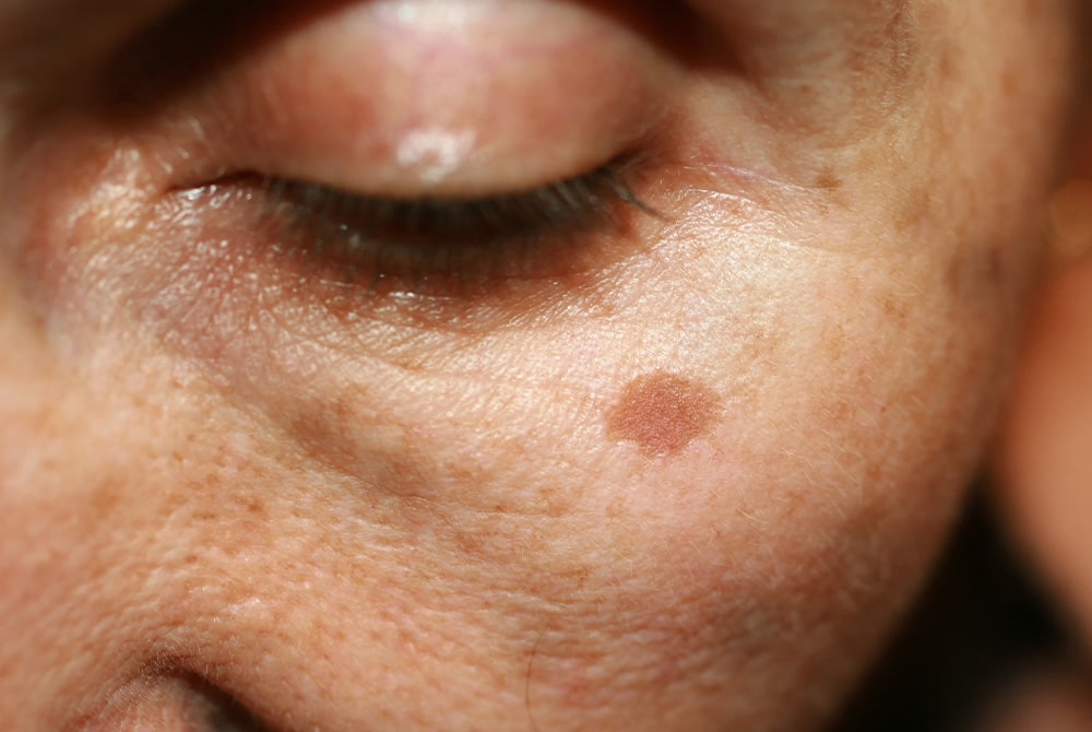 Reclaim Your Radiance with Expert Skin Pigmentation Treatment Southampton 1 Reclaim Your Radiance with Expert Skin Pigmentation Treatment Southampton