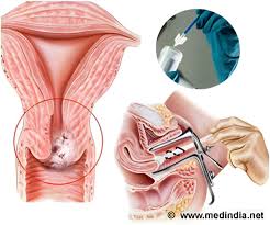 Europe Cervical Cancer Screening Market Size And Forecast Report 2024-2032 1 Europe Cervical Cancer Screening Market Size And Forecast Report 2024-2032