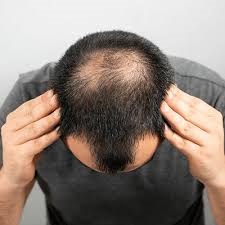 Is a Hair Transplant in Dubai Worth the Investment? 1 Is a Hair Transplant in Dubai Worth the Investment?