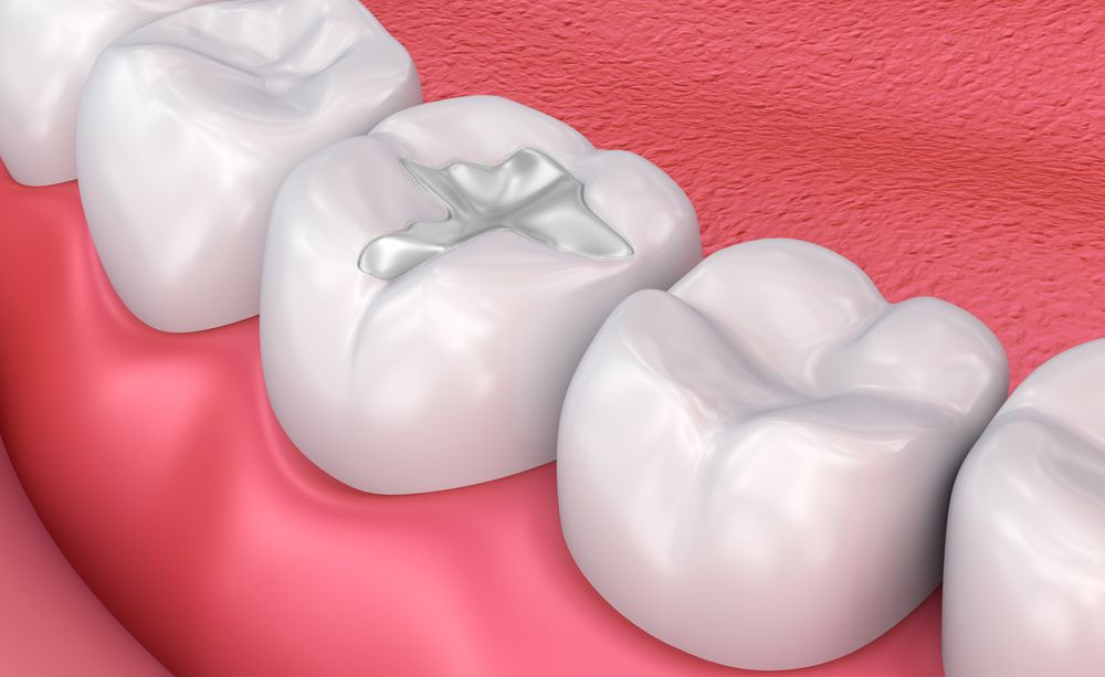 Reliable Pediatric Dental Fillings in Laurel MT for Your Child's Smile 1 Reliable Pediatric Dental Fillings in Laurel MT for Your Child’s Smile