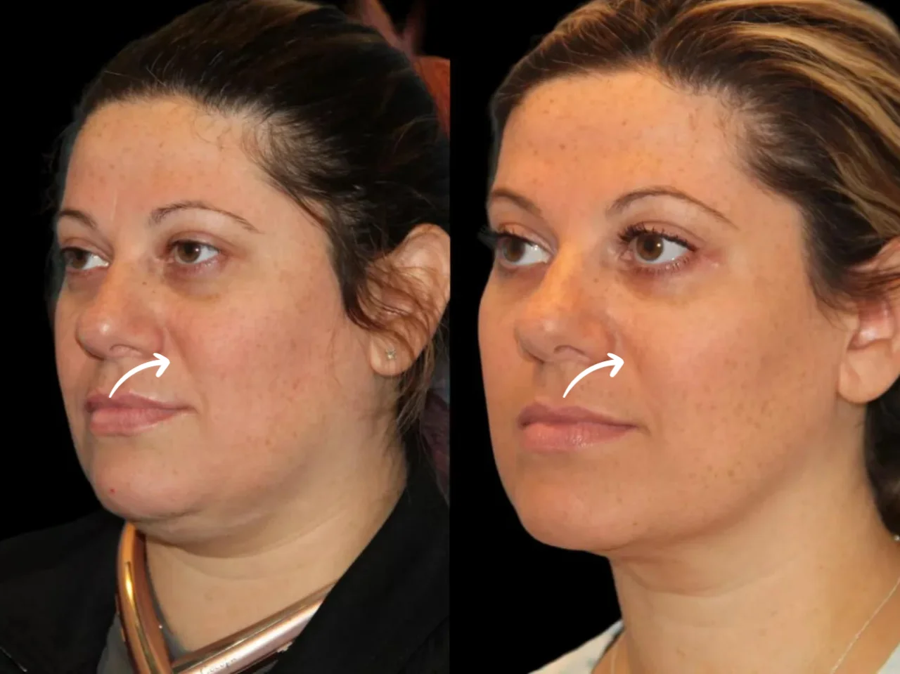 Combining Sculptra with Other Treatments: Advice from the Best Doctors in dubai 1 Combining Sculptra with Other Treatments: Advice from the Best Doctors in dubai