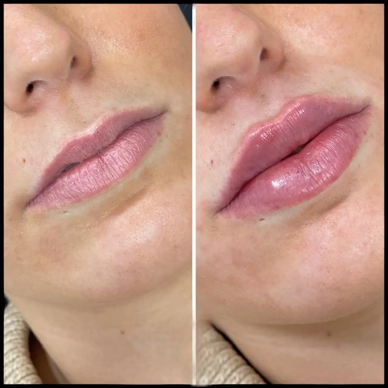 Juvederm treatments in Dubai: What Influences Longevity?