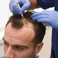 هلالعالية تعني تكلفة زراعة الشعر في دبي؟