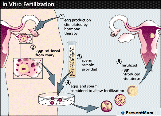 Australian Concept Infertility Your Path to Parenthood with the Best IVF Treatment and Infertility Specialist in Pakistan 1 Australian Concept Infertility Your Path to Parenthood with the Best IVF Treatment and Infertility Specialist in Pakistan