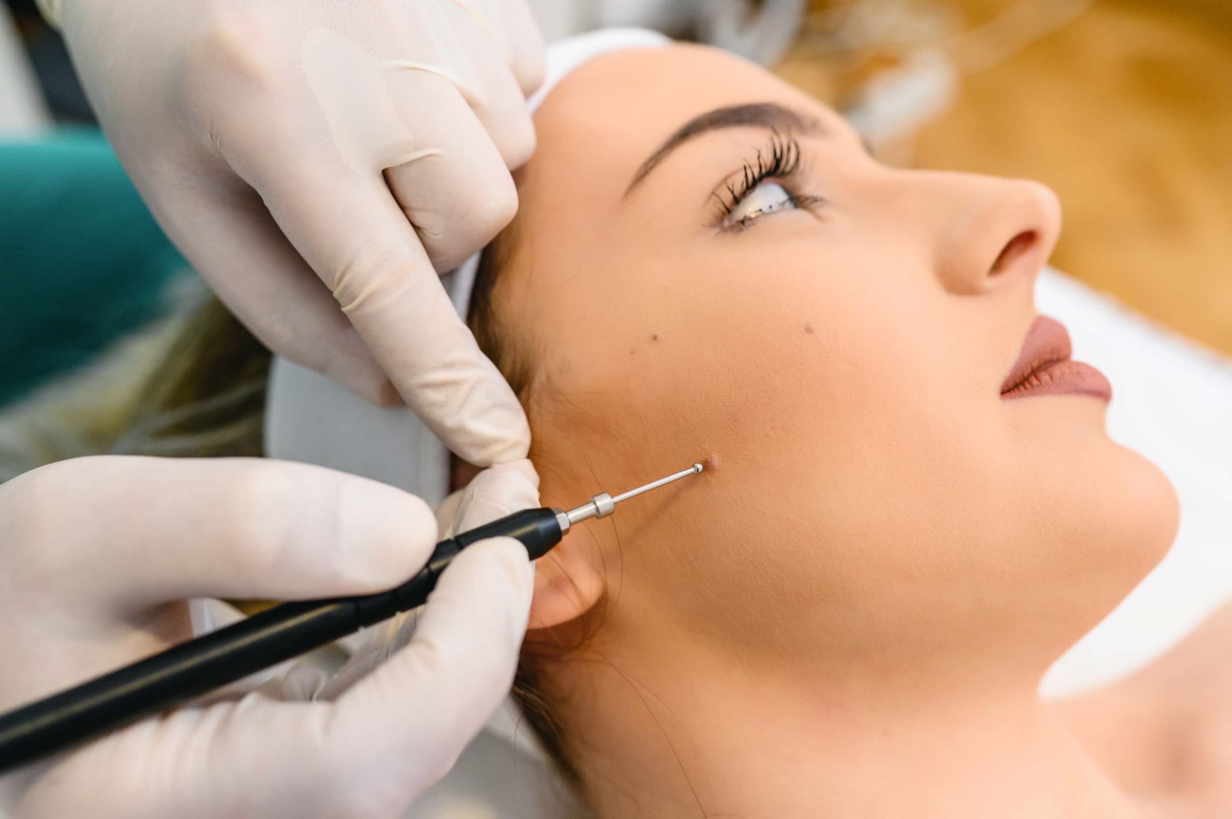 How to Remove Skin Tags in Sydney Without Leaving Scars 1 How to Remove Skin Tags in Sydney Without Leaving Scars