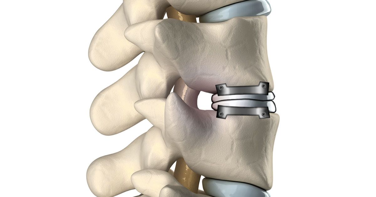 Why Consider Disc Replacement Surgery? Unveiling Its Numerous Benefits 1 Why Consider Disc Replacement Surgery? Unveiling Its Numerous Benefits