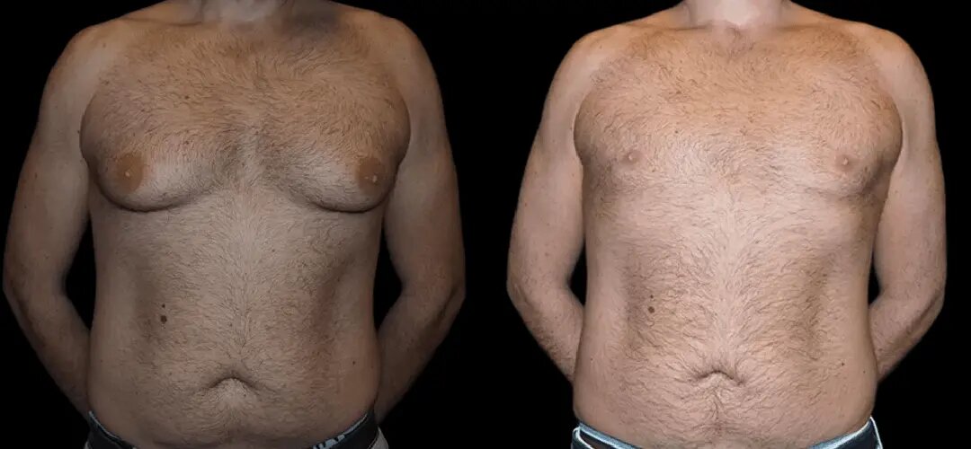 Transform Your Chest with Best Gynecomastia Surgeons in dubai 1 Transform Your Chest with Best Gynecomastia Surgeons in dubai