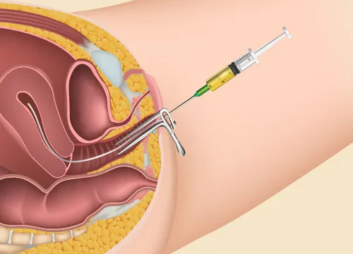 The Role of Ovulation Induction in IUI Fertility Treatment 1 The Role of Ovulation Induction in IUI Fertility Treatment