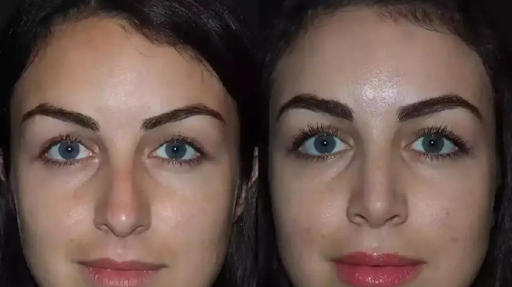A Comprehensive Guide to Rhinoplasty with the Best Doctors in Dubai 1 A Comprehensive Guide to Rhinoplasty with the Best Doctors in Dubai