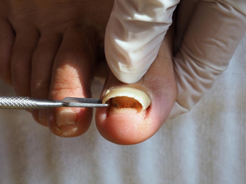 The Complete Guide to Ingrown Toenail Removal in San Antonio: Relief at Your Fingertips 1 The Complete Guide to Ingrown Toenail Removal in San Antonio: Relief at Your Fingertips