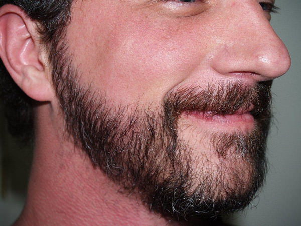 Is a Beard Hair Transplant in Dubai Worth the Investment? 1 Is a Beard Hair Transplant in Dubai Worth the Investment?