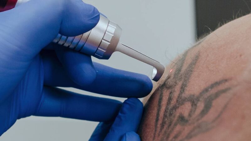 Tattoo Removal in Dubai: Your Guide to a Fresh Start