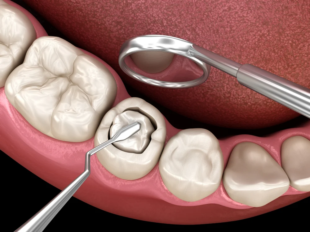 What Is the Procedure for Getting a Composite Resin Filling? 1 What Is the Procedure for Getting a Composite Resin Filling?