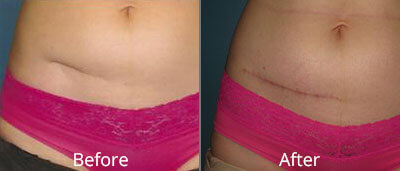 Fast-Track Your Skin Recovery Post-Surgical Scar Treatment in Dubai