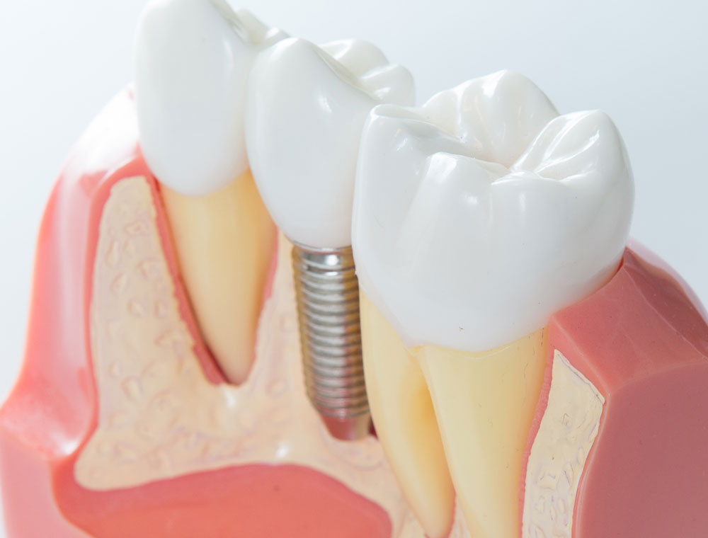What Are the Signs of an Infected Tooth That Needs a Root Canal?