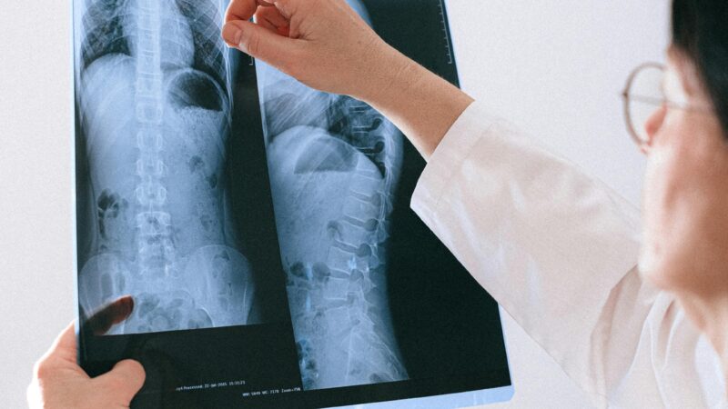 Trusted Spine Surgery with Rods and Screws for Lasting Relief
