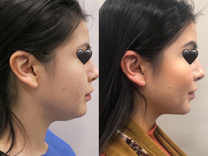 How Long Does It Take to Recover from Eyelid Surgery?