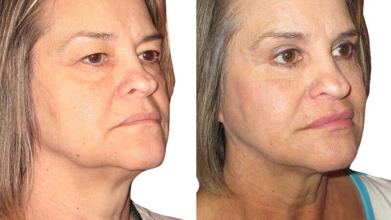 Can Neck Liposuction Get Rid of a Double Chin?
