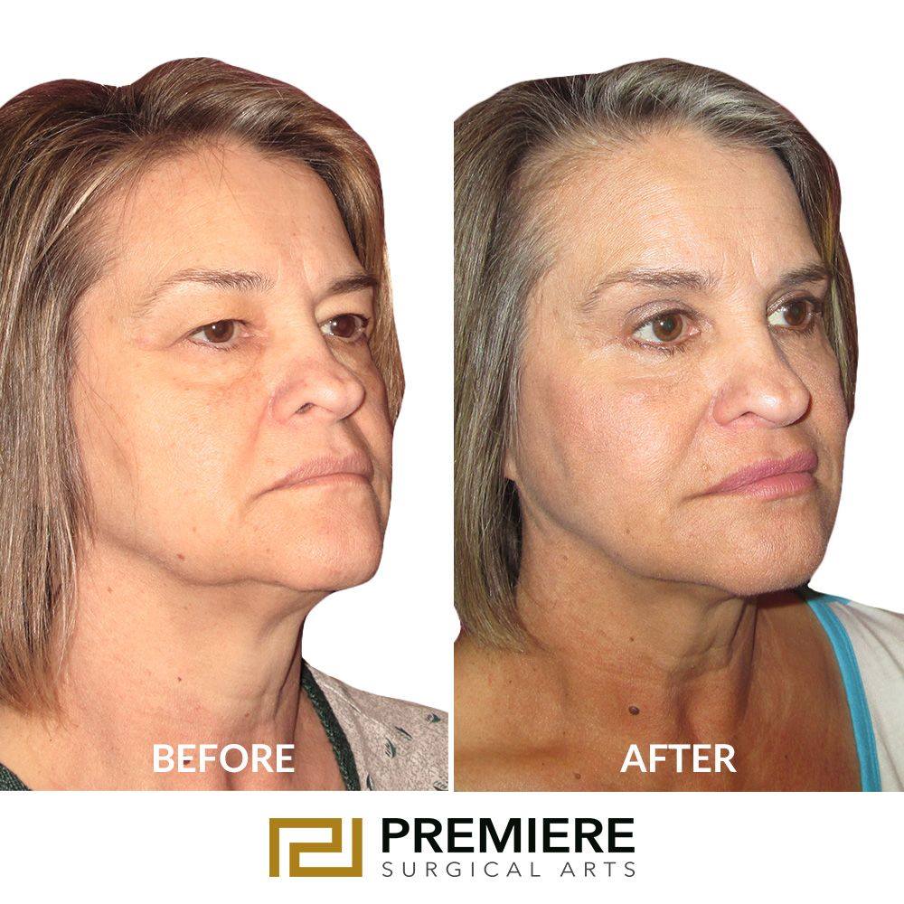 Can Neck Liposuction Get Rid of a Double Chin? 1 Can Neck Liposuction Get Rid of a Double Chin?