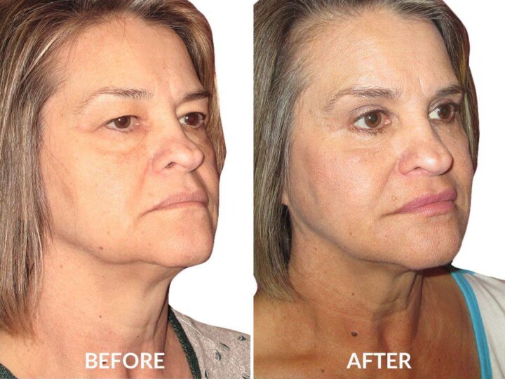 What Are the Risks or Side Effects of Neck Liposuction?