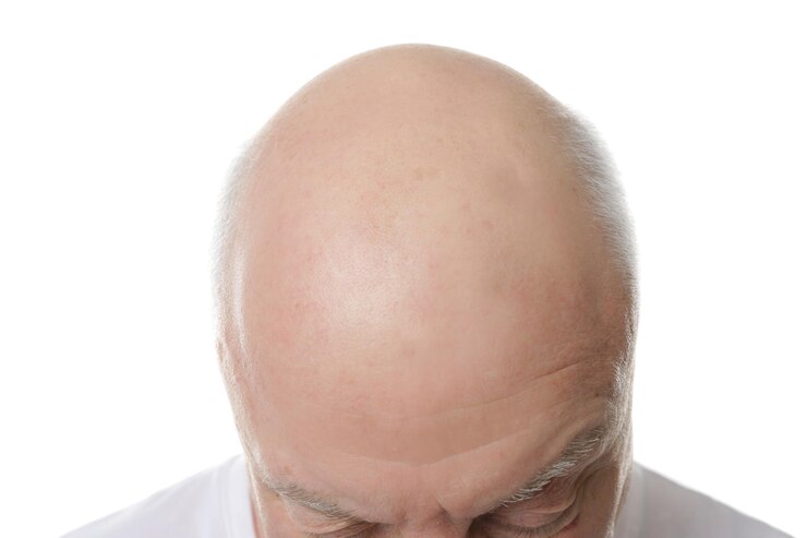 What Are Experts Saying About Non-Surgical Hair Replacement? 1 What Are Experts Saying About Non-Surgical Hair Replacement?