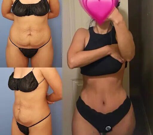 Finding the Best Tummy Tuck Surgeon in dubai: What You Need to Know