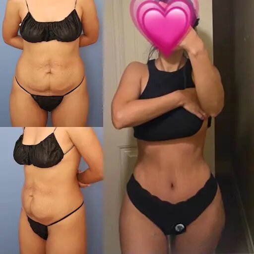 Finding the Best Tummy Tuck Surgeon in dubai: What You Need to Know