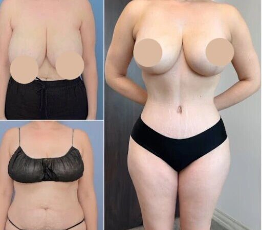 Tummy Tuck in Dubai: Real Results and Success Stories
