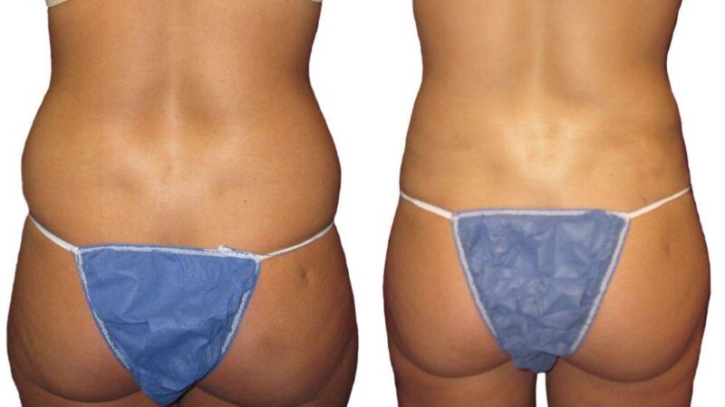 Can a Brazilian Butt Lift Improve My Body Shape?