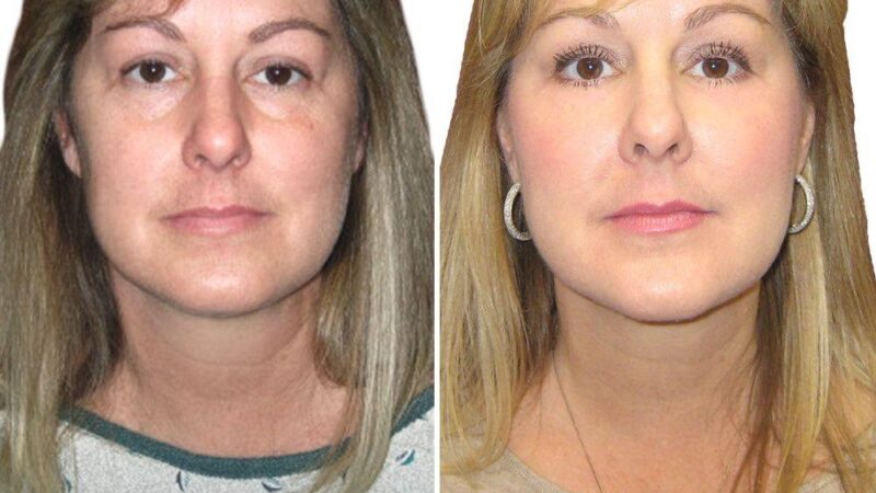 Why Choose Cosmetic Surgery in Houston for Your Aesthetic Goals?