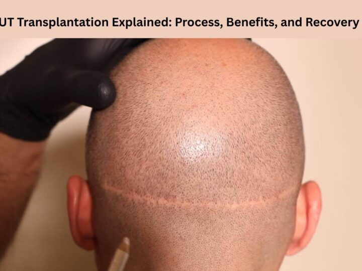 FUT Transplantation Explained: Process, Benefits, and Recovery