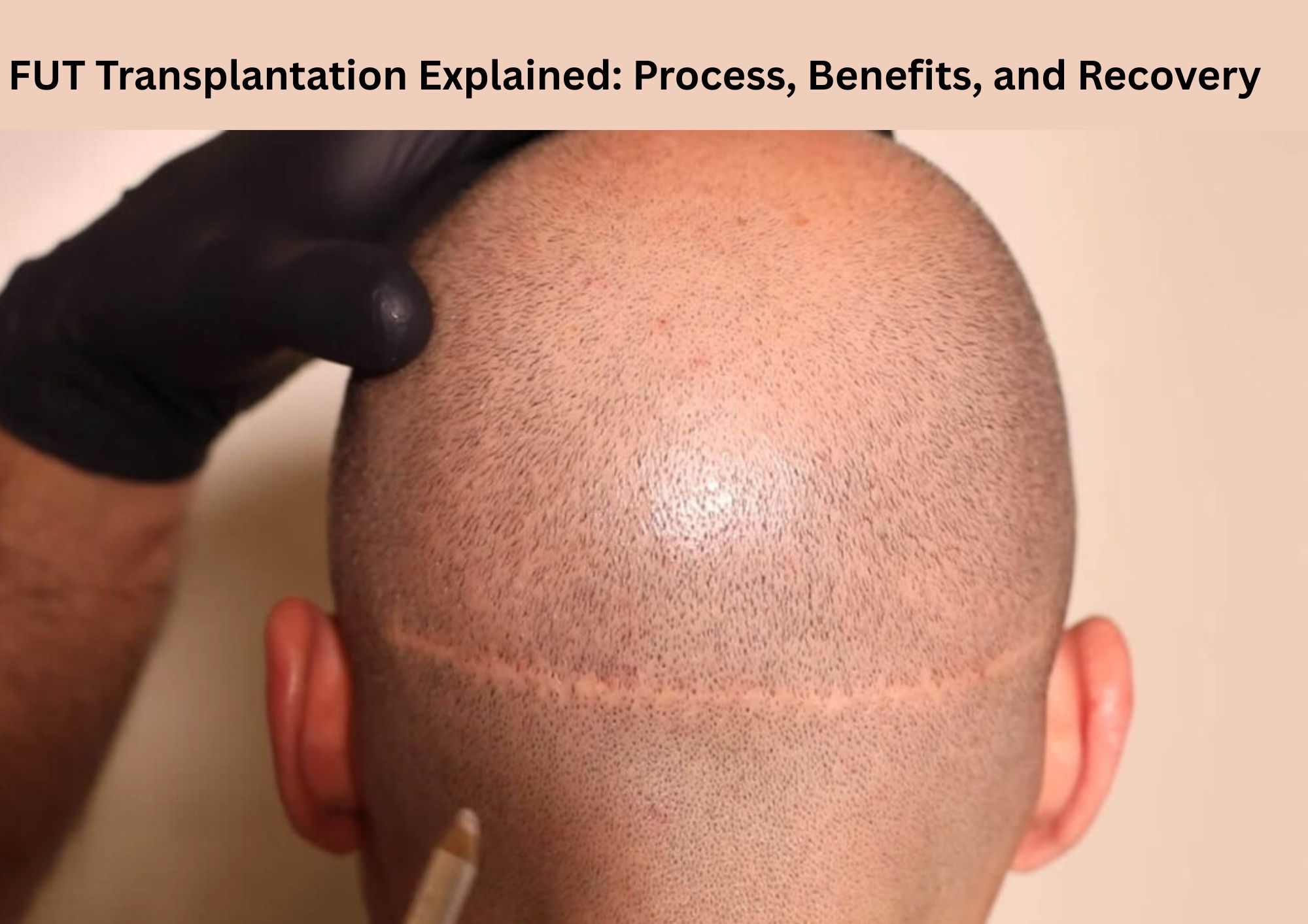 FUT Transplantation Explained: Process, Benefits, and Recovery 1 FUT Transplantation Explained: Process, Benefits, and Recovery
