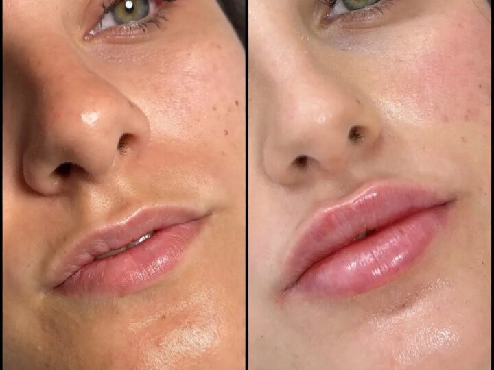 Best Aesthetic Clinic in dubai for Fillers: Sculpt Your Jawline