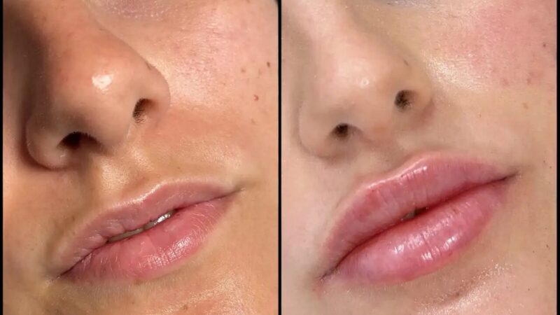 Best Aesthetic Clinic in dubai for Fillers: Sculpt Your Jawline