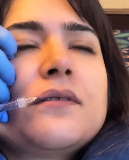 What Are the Benefits of Microneedling for Hair Loss?